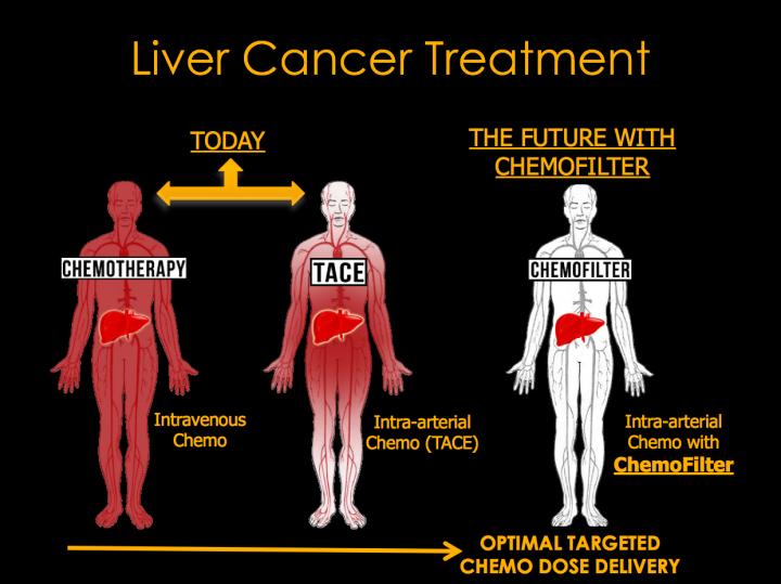 Liver Cancer Treatments
