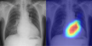 Evaluation of Left Ventricular Ejection Fraction