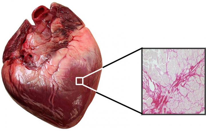Myocardium Image of a Patient With Heart Failure