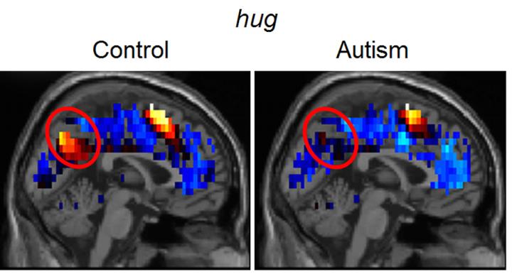 Carnegie Mellon Researchers Discover Brain Representations of Social Thoughts Accurately Predict Autism Diagnosis