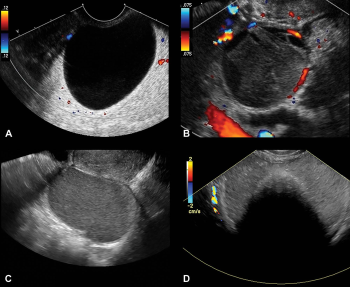 Researchers Use Ultrasound to Predict Ovarian Cancer