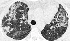 Lung image