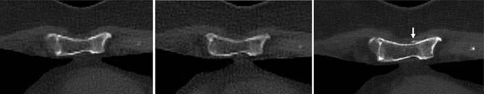Novel Photon-Counting CT Improves Myeloma Bone Disease Detection