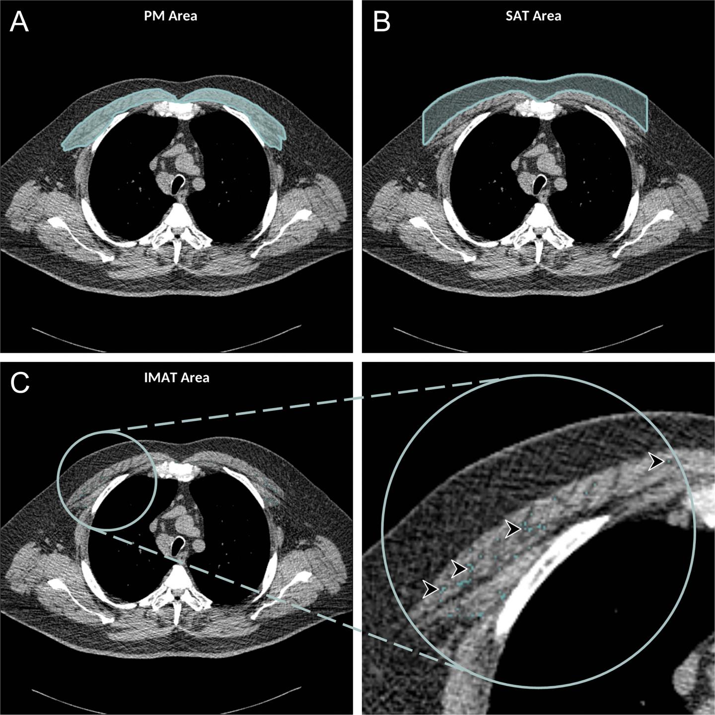 Chest CT Illuminates Mortality Risk in People with COPD