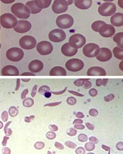 Into Adulthood, Sickle Cell Patients Rely on ER