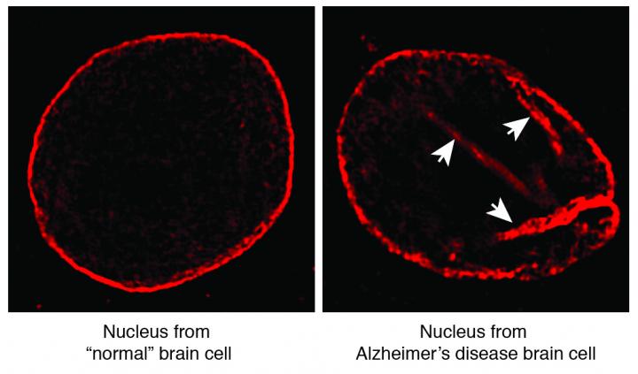 Brain Cell Death in Alzheimer's Linked to Structural Flaw