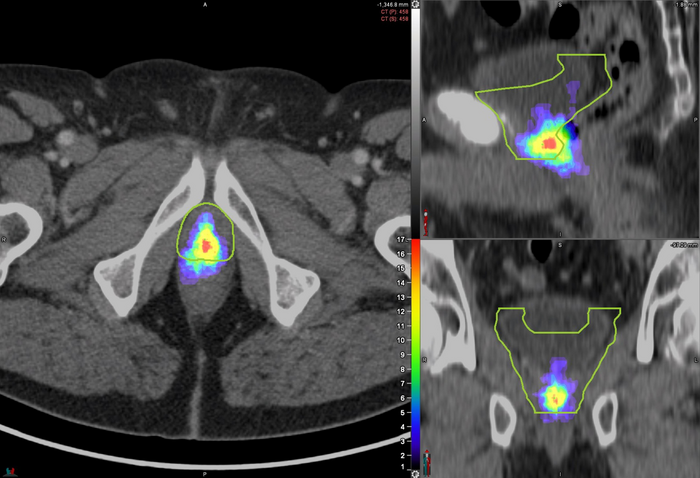 Mapa cieplna rozkładu powtórzeń PSMA PET na łóżku prostaty zmapowana na modelu anatomicznym pacjenta.