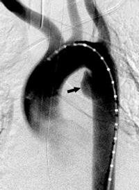 Aorta Angiogram, Figure 1