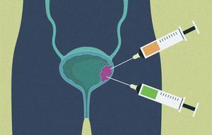 Illustration of bladder and experimental treatment