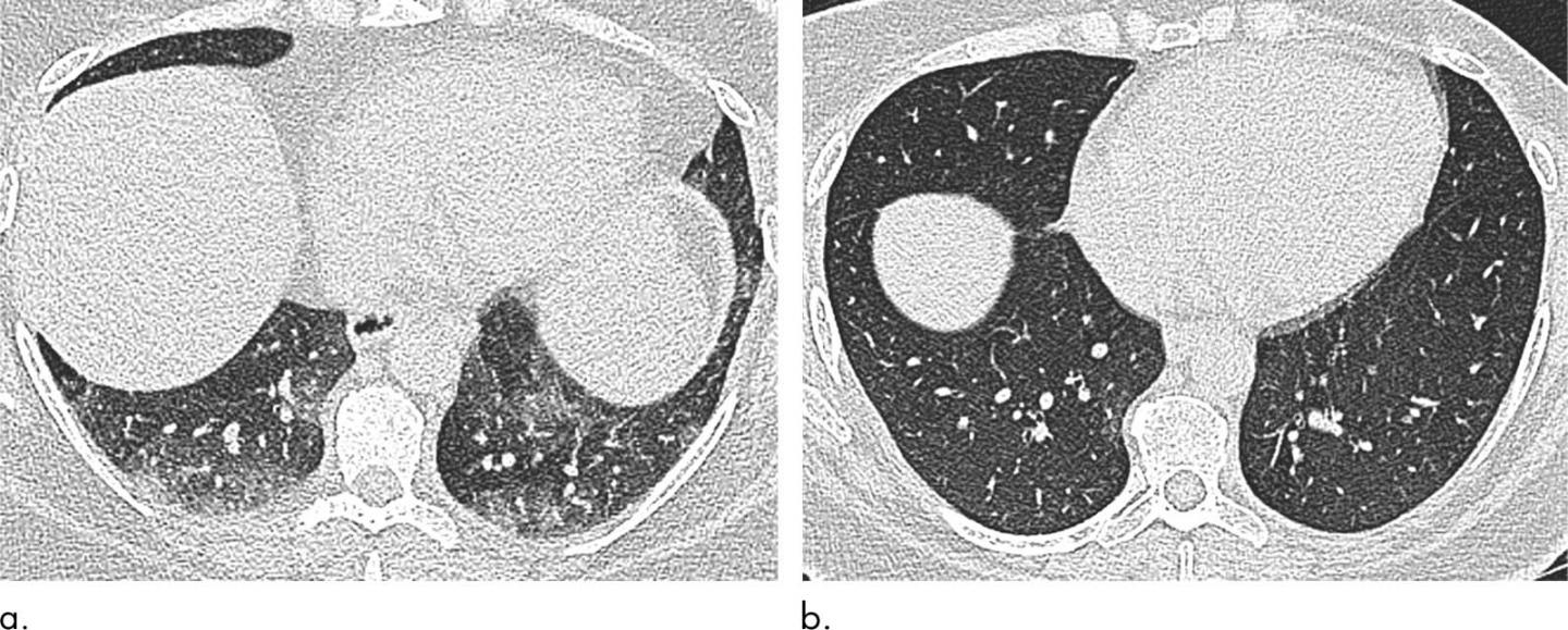 Weight Loss Surgery Improves Breathing Issues in Obese Patients