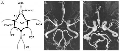 Incomplete Circle of Willis More Common in Subjects with Migraine