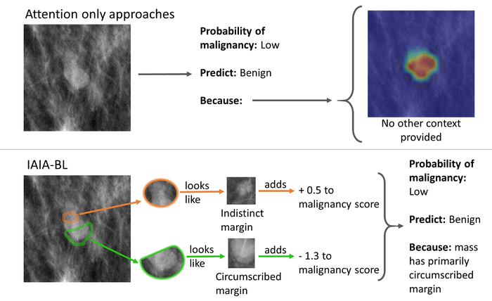 Breast Cancer Vision