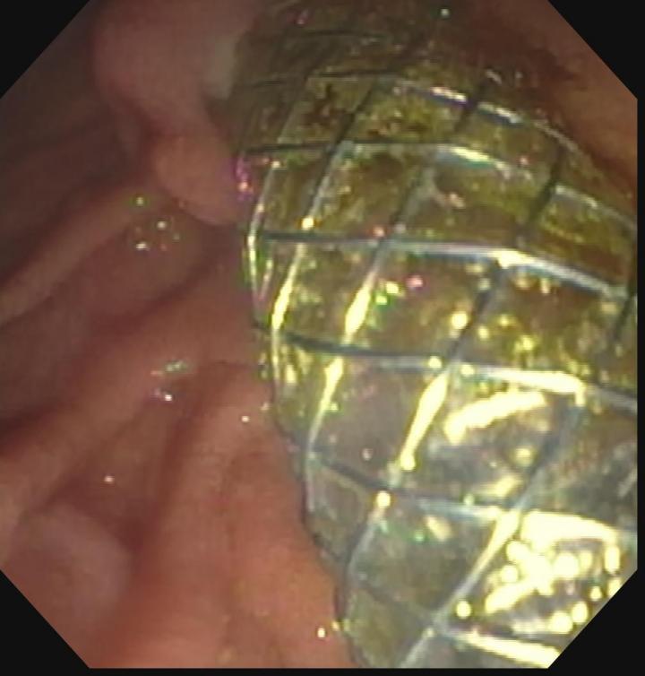 Self-Expanding Metallic Stent