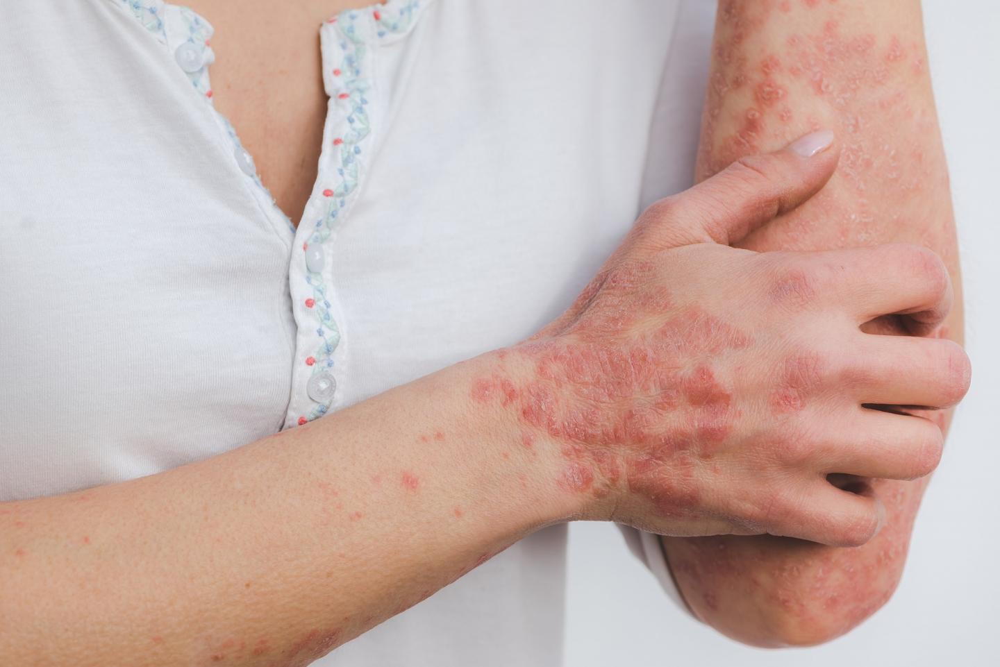 Relationship Between Psoriasis Treatments and Cardiovascular Risk Explained