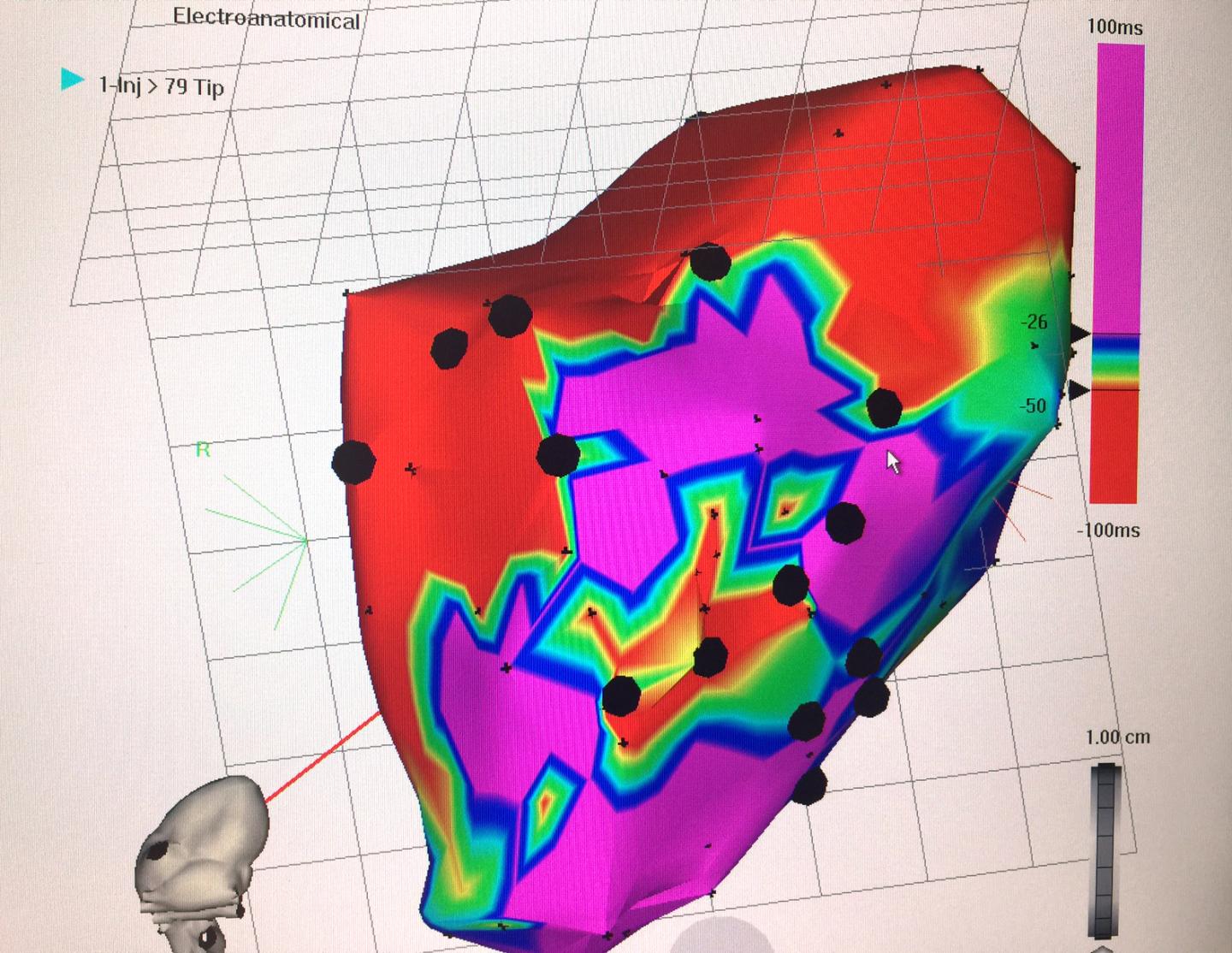 Targeting Cell Therapy to Damaged Hearts