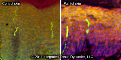 Distribution of CGRP in Healthy and Painful Skin
