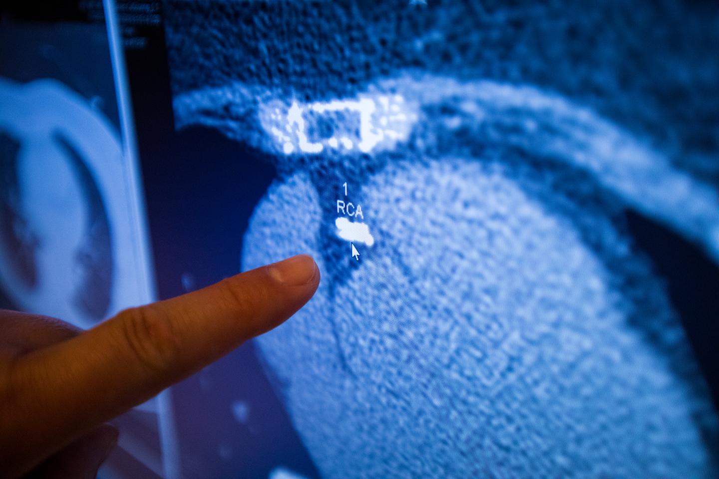 Xray Image of Calcium Scoring Exam