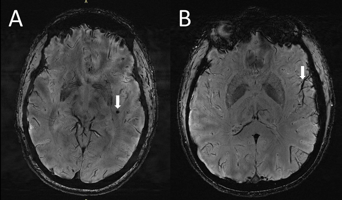 migraine and mri abnormalities