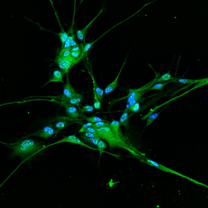 A higher concentration of chloride ions in cells promotes tumor progression