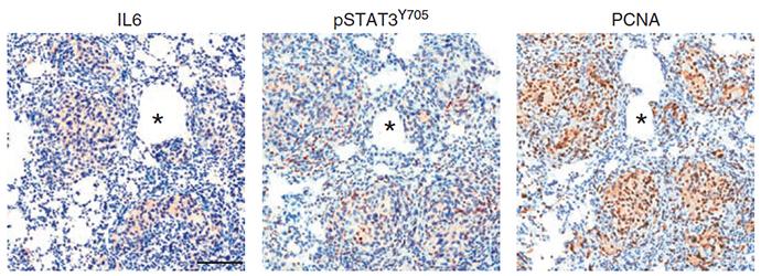 A Valuable Marker for Prostate Cancer Metastasis