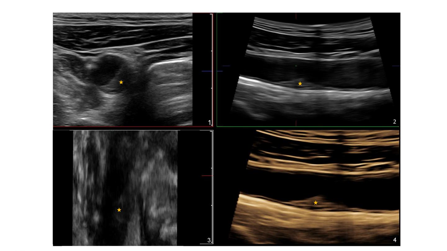 Atherosclerotic Plaque