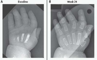 Hypophosphatasia Treatment