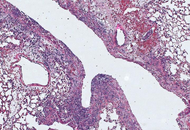 Infected Lung Tissue