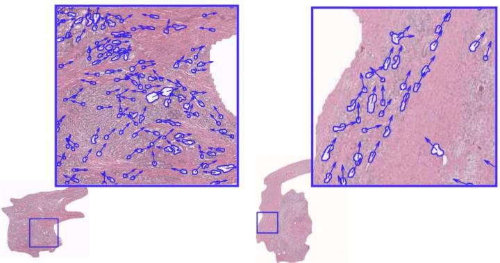 Subtle Changes in Benign Tissues