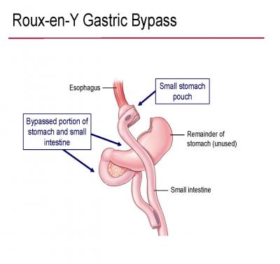 Roux-en-Y Gastric Bypass