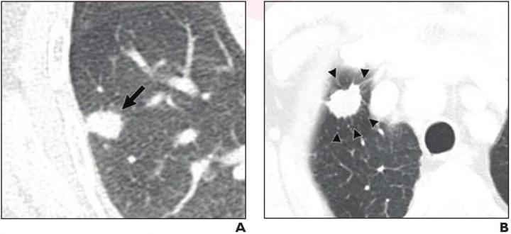 Axial contrast-enhanced CT images in patients with and without the presence of pathologic lymphovascular invasion
