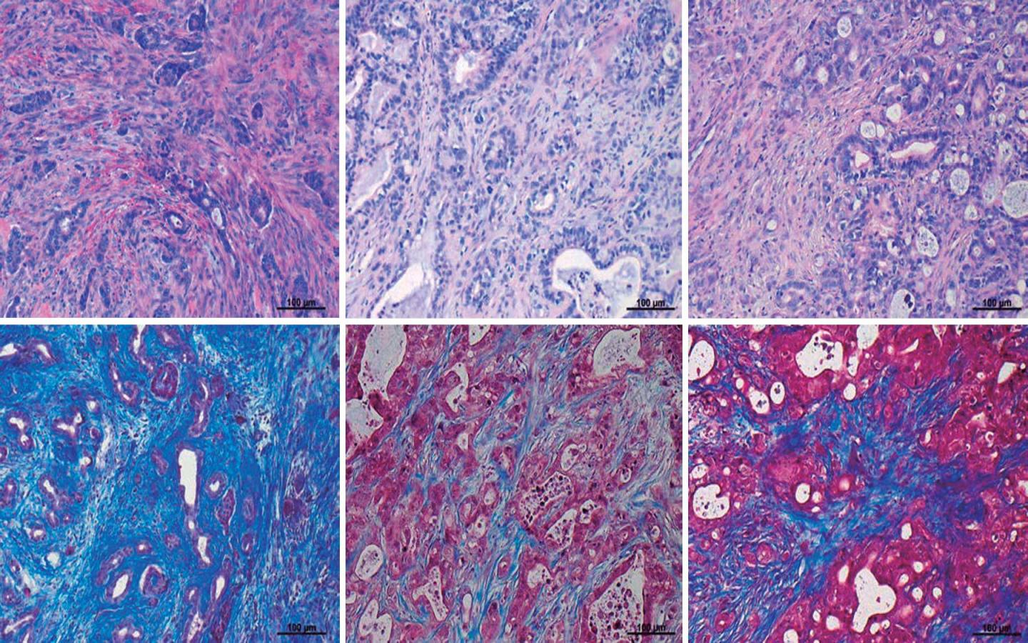 Tumors in Organoid Mouse Model of PDA