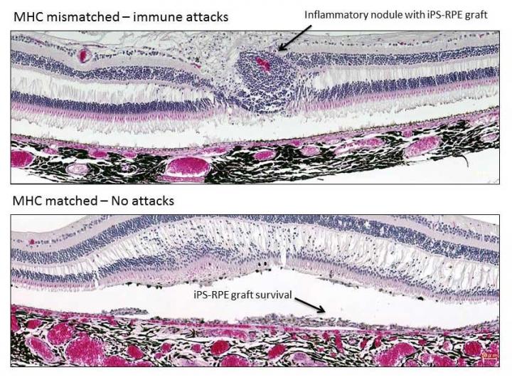 Results of Immune-Matched Retinal Transplantation