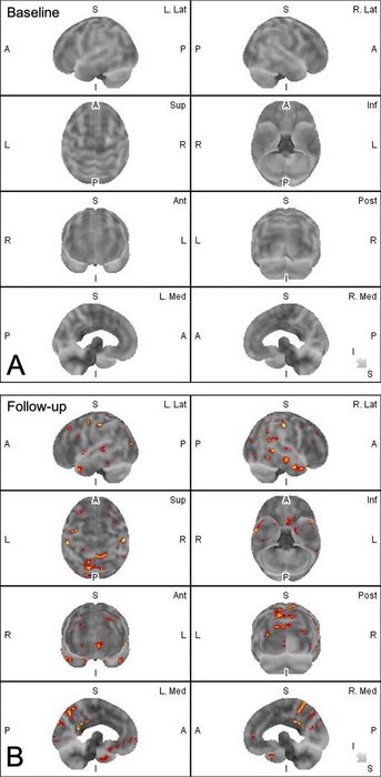 Recurrent Brain Trauma May Increase Alzheimer’s Risk