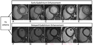 T1-Based Criteria for Myocarditis on Cardiac MRI in Patients With Recent COVID-19 mRNA Vaccination