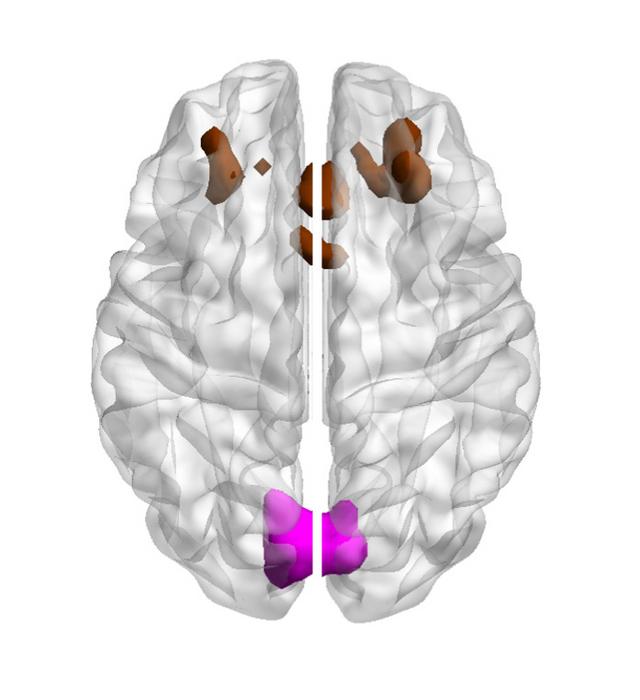Image showing bilateral cuneal and frontal cortex