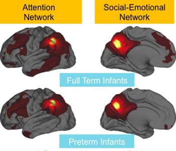 Brains of Preemies Have Weakened Connections