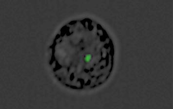 A Monocyte Converted into a Decoy by the Malaria Parasite
