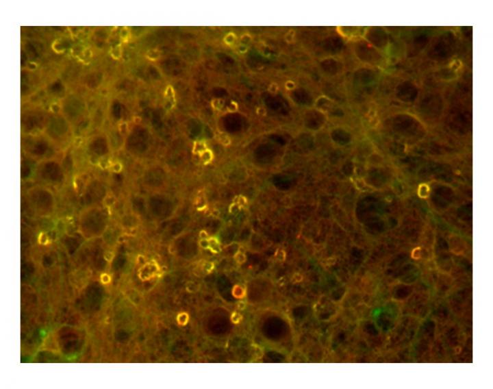 Acetylation and Amyloid Beta Toxicity