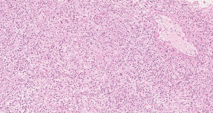 Histological Sample of Nf-1 Tumour