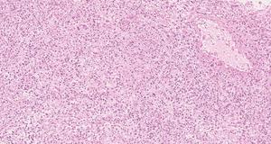 Histological Sample of Nf-1 Tumour