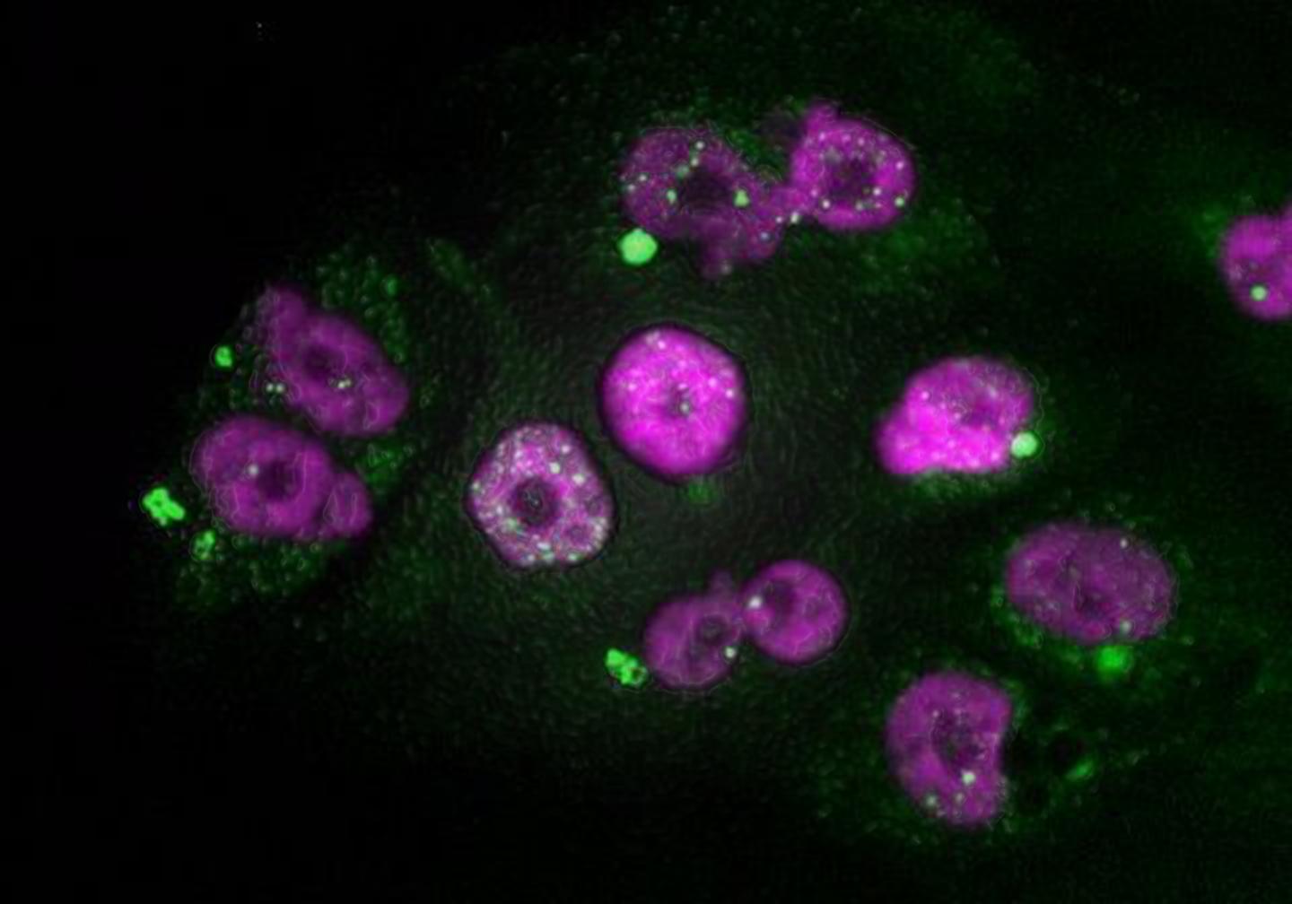 Pancreatic Adenocarcinoma Tumor Cells