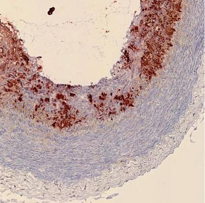 Fatty Arteries to 'Go Green' With New Screening Technique (6 of 9)