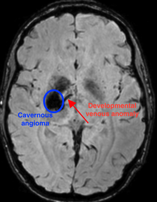 An MRI of a patient with a cavernous angioma