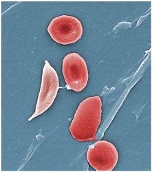 Sickle Cell