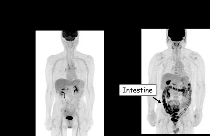 Representative FDG-PET Mri Images of Patients Taking and not Taking Metformin