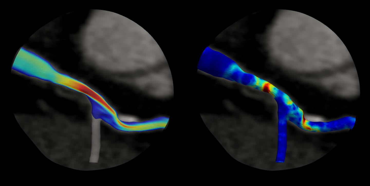 Funding Enables Better Understanding of Blood Flow (Left) and Pressure (Right) in Blockages in Heart