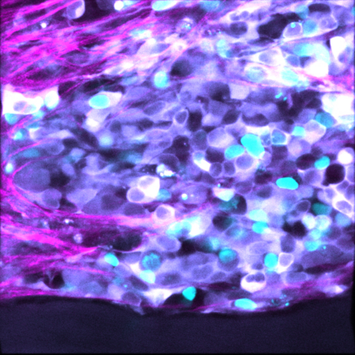 2. Neuroblastoma chemoresistance Credit Max Nobis / Garvan