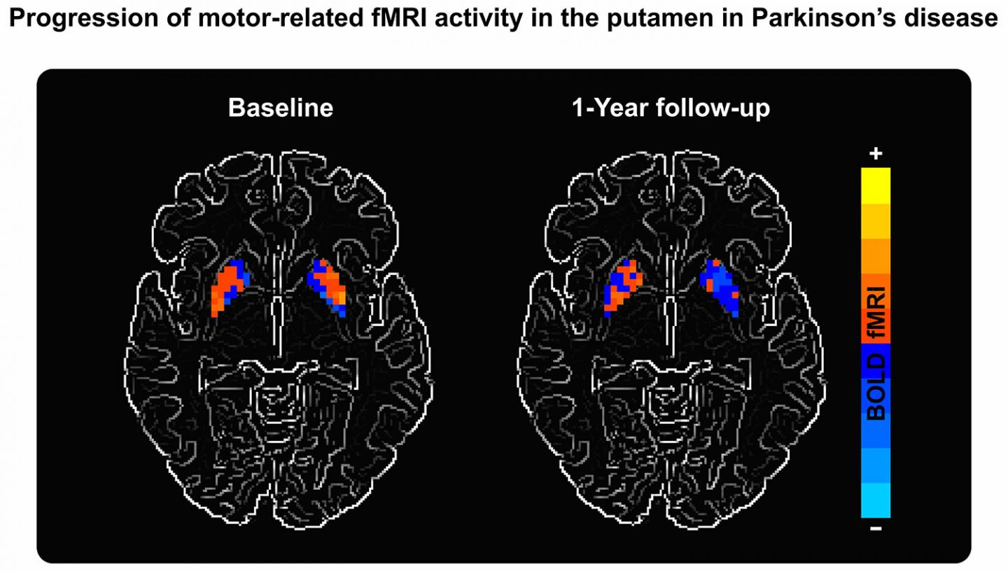 Parkinsons Biomarker