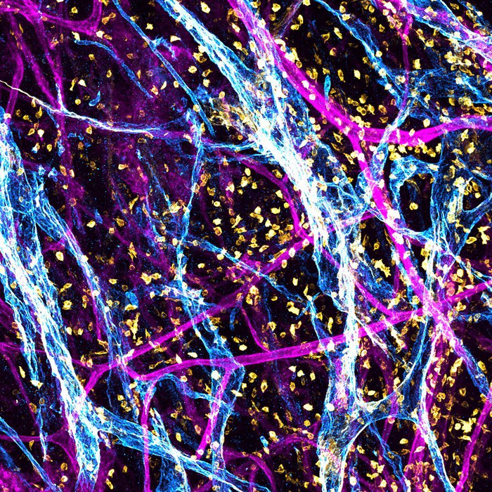 A 3D snapshot of the hidden highways in childhood kidney cancer