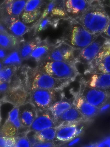 Triple Negative Breast Cancer Cells